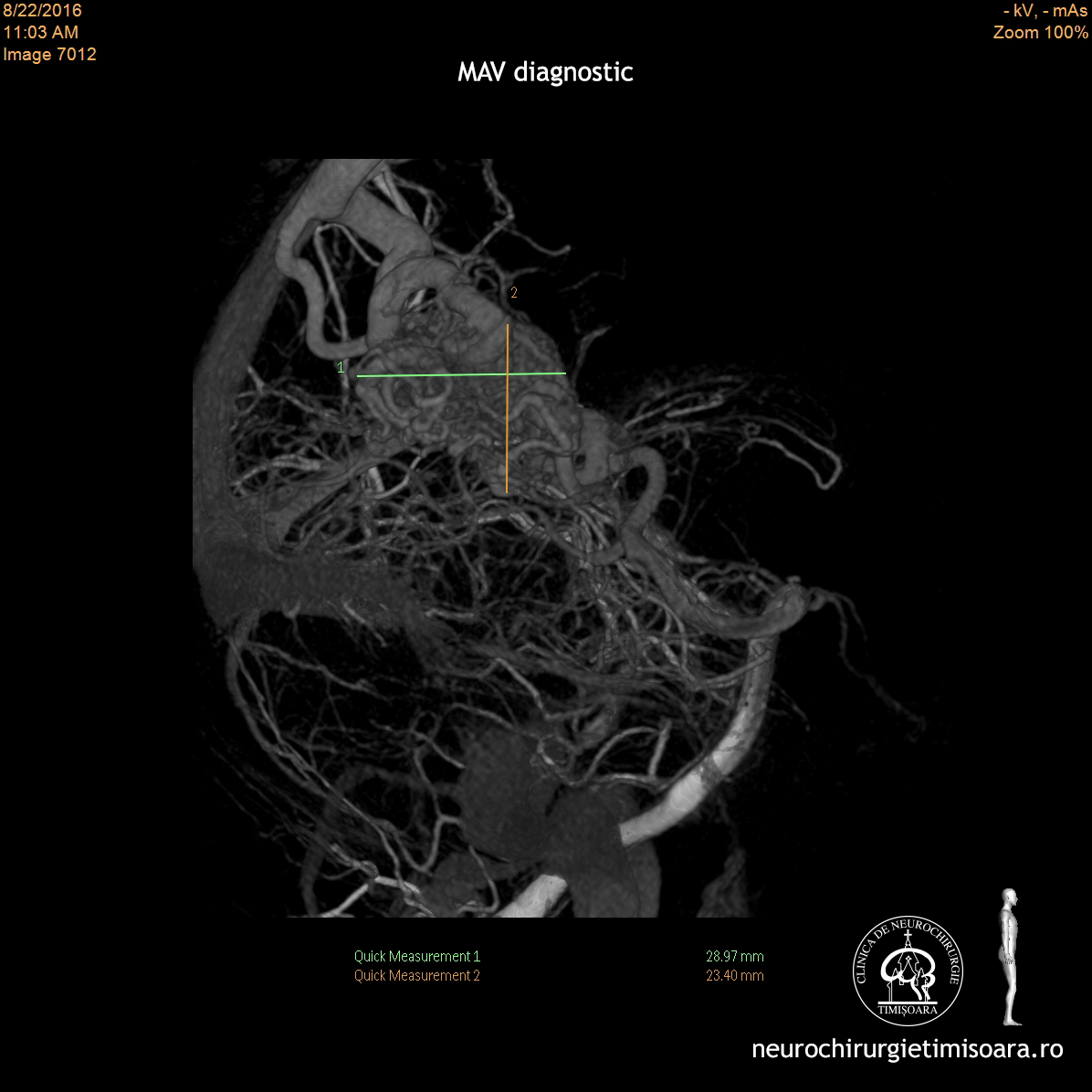 Malformatie arterio-venoasa occipitala nerupta